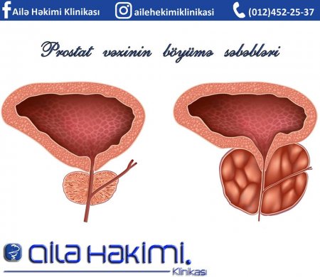Ailə Həkimi Klinikası -  Prostat vəzinin böyümə səbəbləri