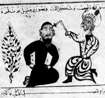 Başda olan yaranın dağlanması əməliyyatı. 12-ci əsr persiya manuskripti Paris milli kitabxana