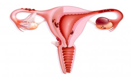 Endometrioz nədir?  