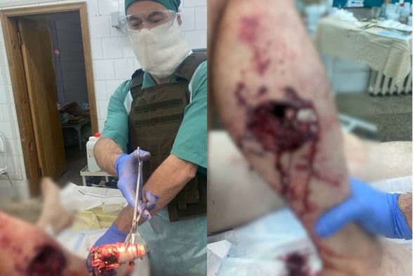Sankt-Peterburda yaralı əsgərin ayağından partlamağa hazır mina parçası çıxarılıb - FOTO