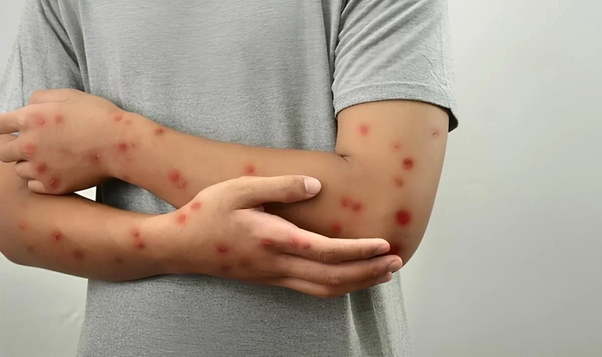 Meymunçiçəyi virusu dəyişir: Alimlər yeni mutasiya dalğasını aşkarladılar